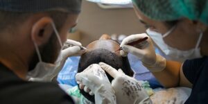 Den ultimative guide til hårtransplantation: Hvordan det fungerer og hvad du kan forvente